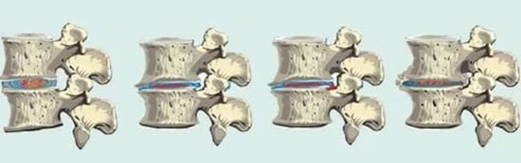 mugurkaula bojājums krūšu kurvja osteohondrozes gadījumā