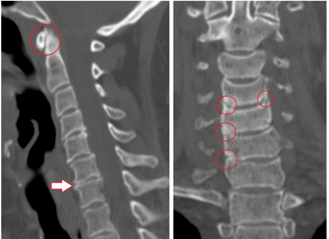 DT skenēšana uzrāda krūšu kurvja osteohondrozes izraisītus bojātus skriemeļus un neviendabīga augstuma diskus