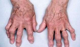 kā atšķirt pirkstu artrītu no artrozes