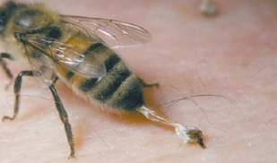 bites gūžas locītavas artrozes ārstēšana