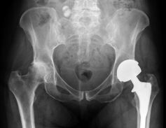 gūžas locītavas artrozes diagnostika