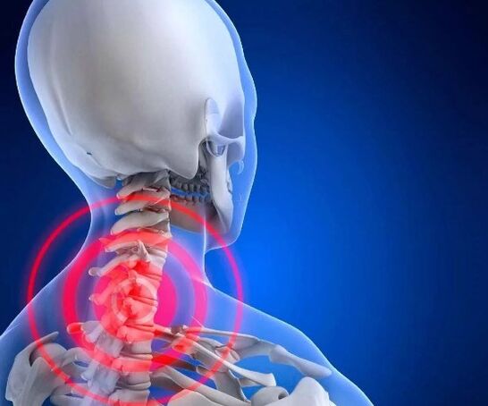 Dzemdes kakla osteohondroze